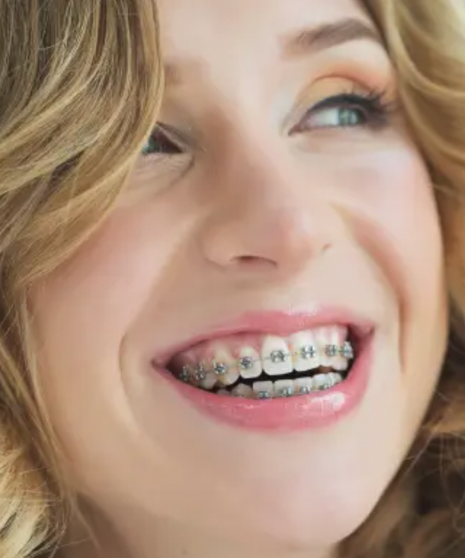 Adult Braces